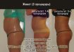 UltraShape. Результаты